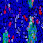 Cancer cells