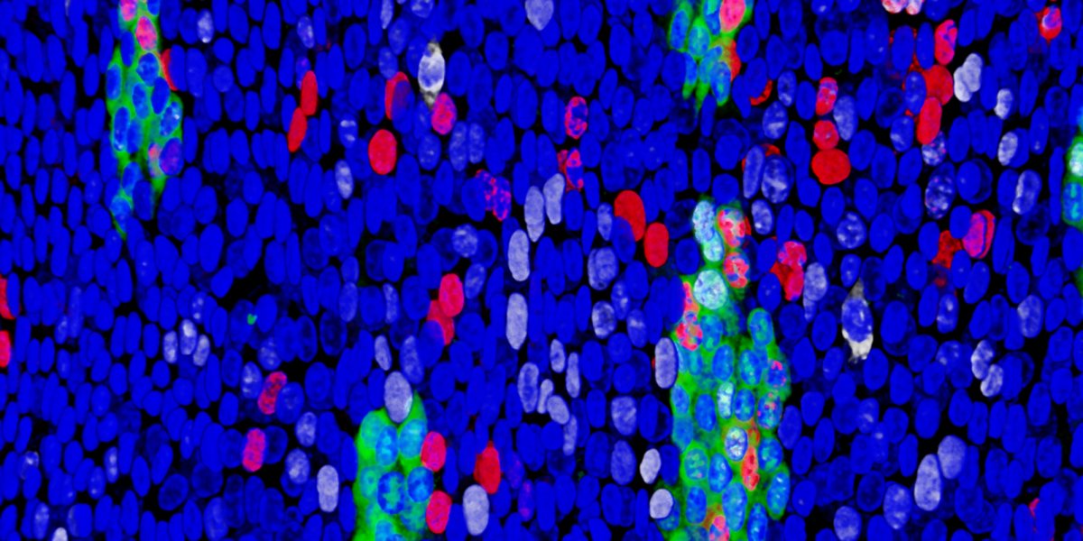 Cancer cells